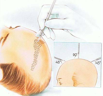 Cirugía de la Alopecia