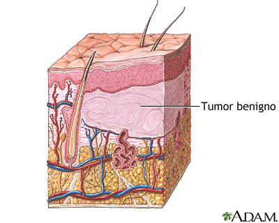 Tumor benigno